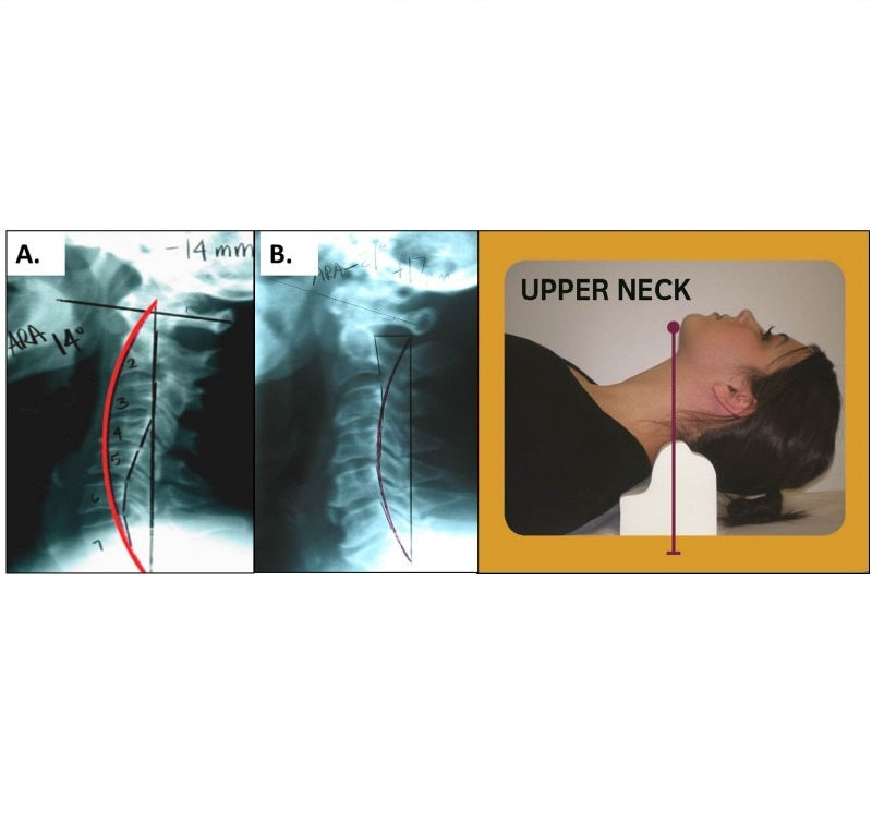 Denneroll - Cervical (Neck) "Orthotic"