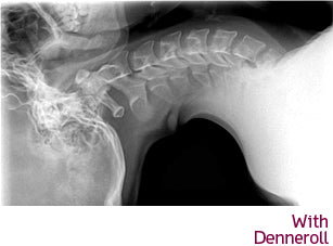 Denneroll - Cervical (Neck) "Orthotic"